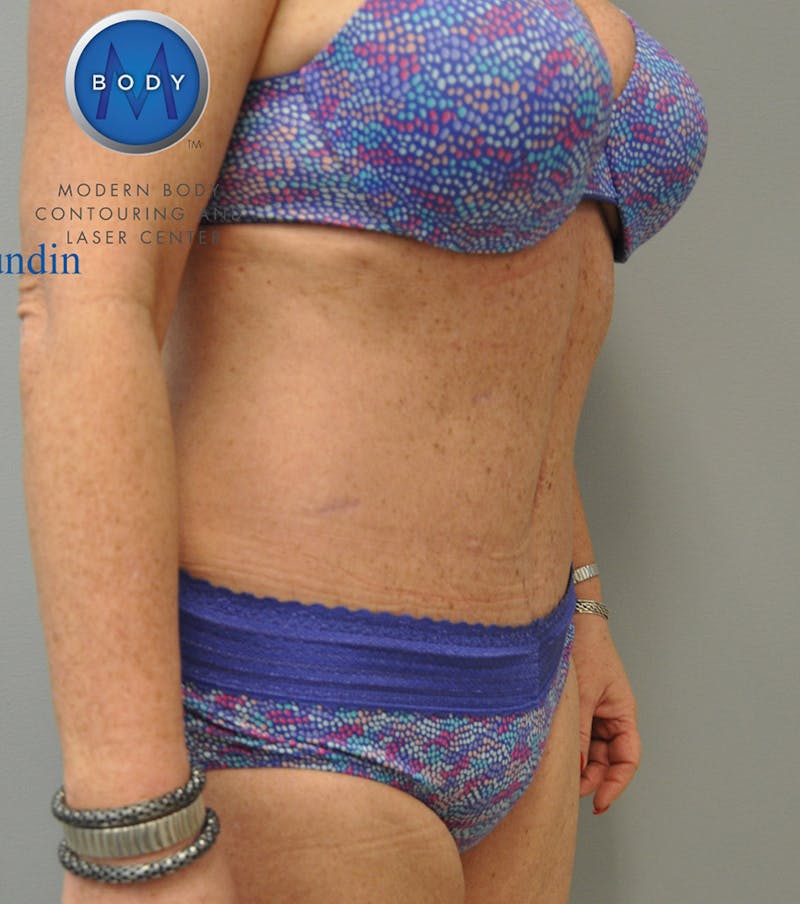 Renuvion J-Plasma Before & After Gallery - Patient 55423321 - Image 10