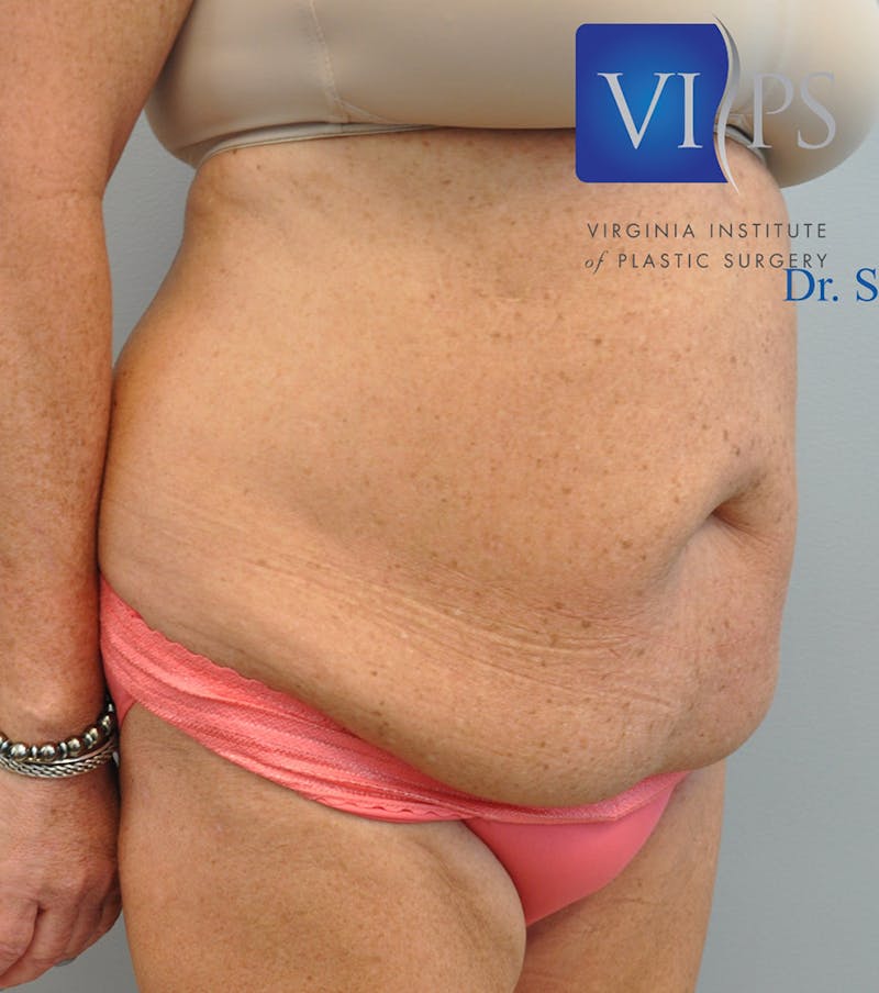 Renuvion J-Plasma Before & After Gallery - Patient 55423321 - Image 9