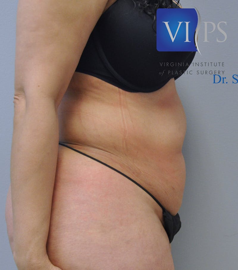 Liposuction Before & After Gallery - Patient 211876589 - Image 3