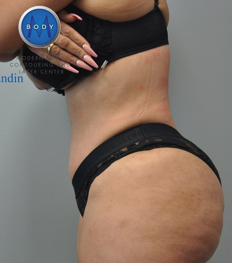 Liposuction Before & After Gallery - Patient 211876589 - Image 6