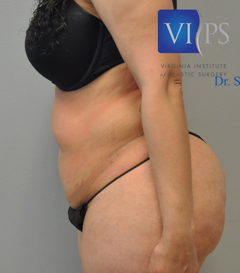 Renuvion J-Plasma Before & After Gallery - Patient 211876560 - Image 5