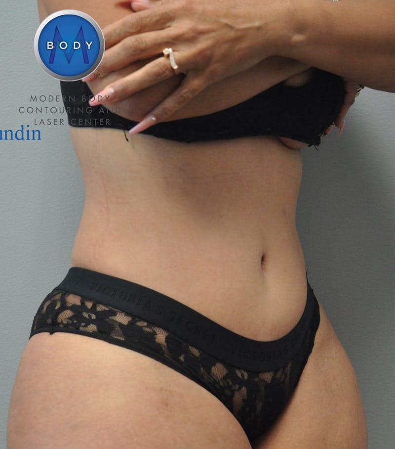 Liposuction Before & After Gallery - Patient 211876589 - Image 8
