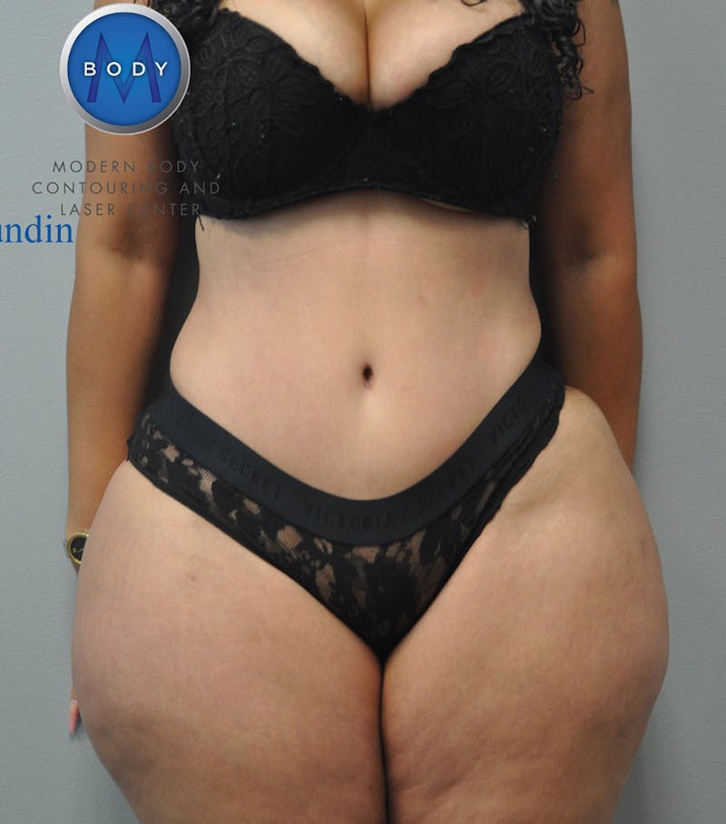 Liposuction Before & After Gallery - Patient 211876589 - Image 10