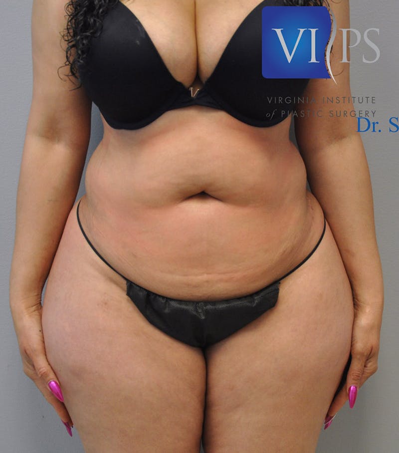 Liposuction Before & After Gallery - Patient 211876589 - Image 9