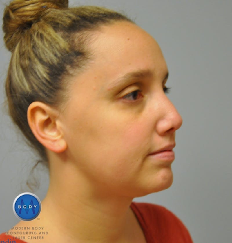 J-Plasma Neck Lift Before & After Gallery - Patient 55423338 - Image 4