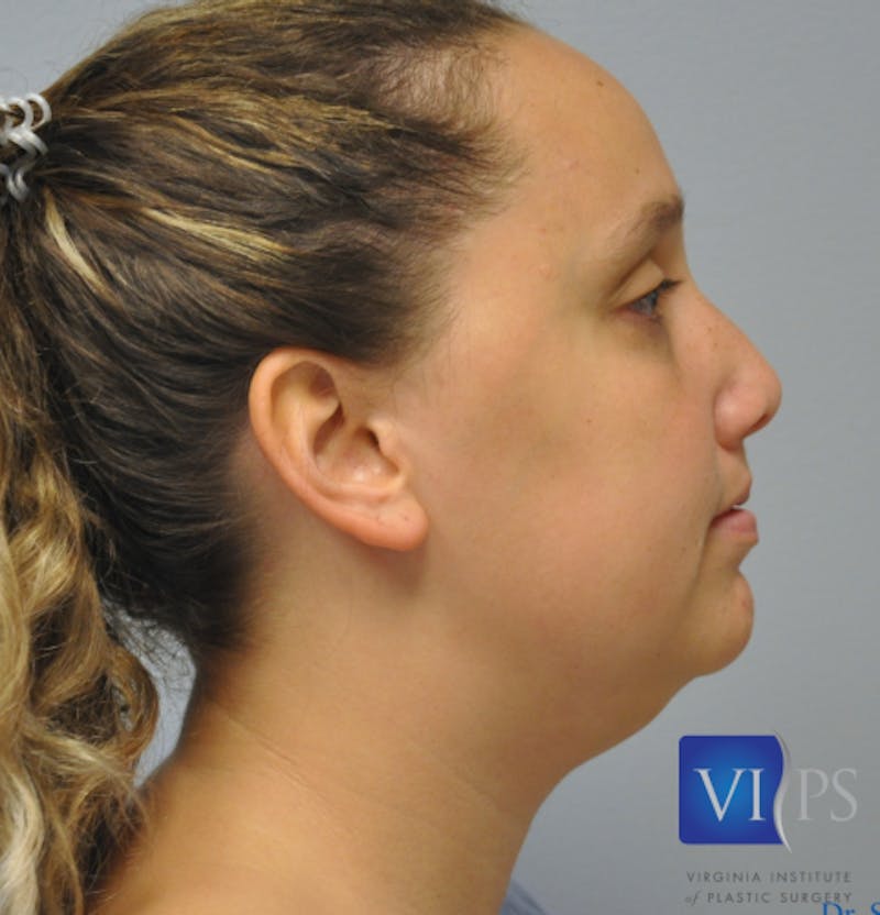 J-Plasma Neck Lift Before & After Gallery - Patient 55423338 - Image 5