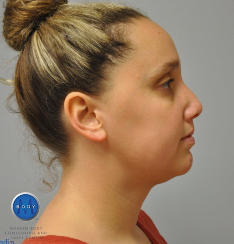 J-Plasma Neck Lift Before & After Gallery - Patient 55423338 - Image 6