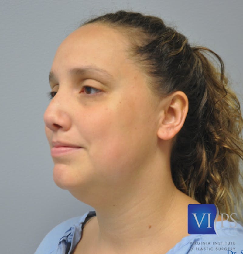 J-Plasma Neck Lift Before & After Gallery - Patient 55423338 - Image 7