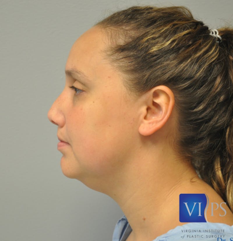 J-Plasma Neck Lift Before & After Gallery - Patient 55423338 - Image 9