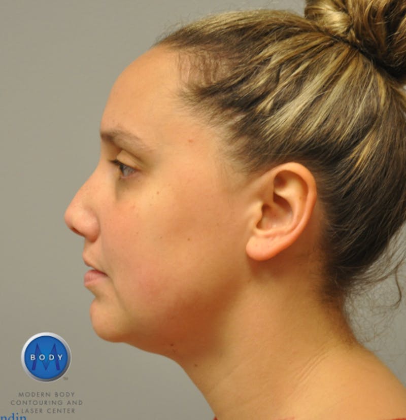 J-Plasma Neck Lift Before & After Gallery - Patient 55423338 - Image 10