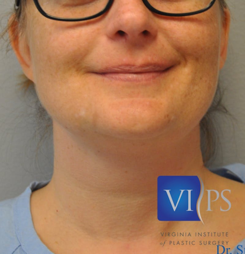 J-Plasma Neck Lift Before & After Gallery - Patient 55423341 - Image 1
