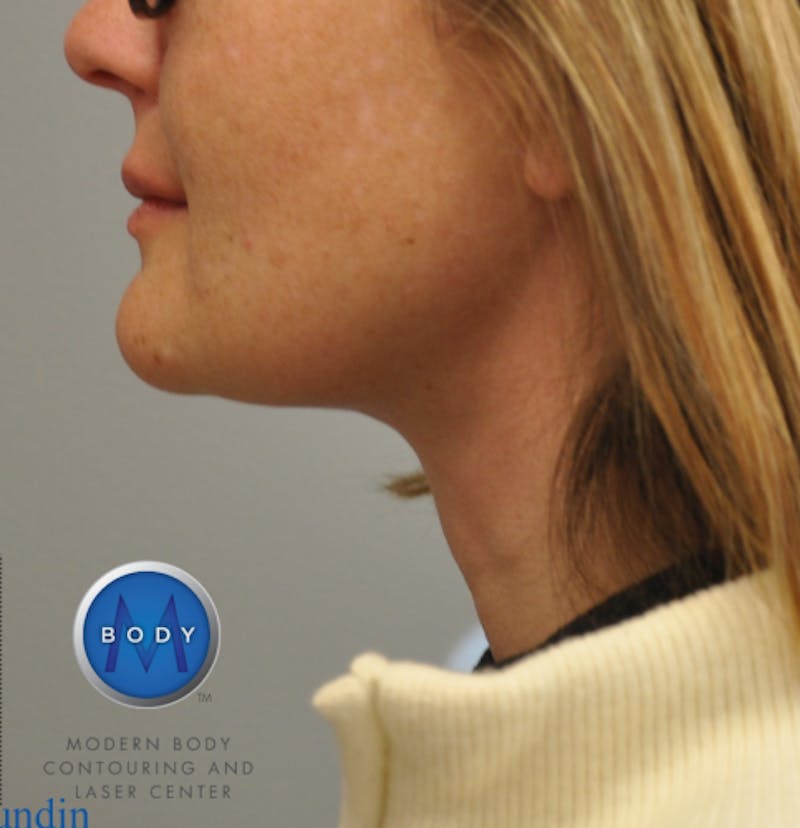 J-Plasma Neck Lift Before & After Gallery - Patient 55423341 - Image 6