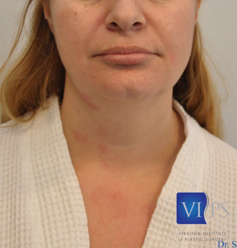 J-Plasma Neck Lift Before & After Gallery - Patient 55423353 - Image 1