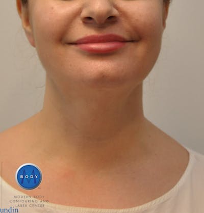 J-Plasma Neck Lift Before & After Gallery - Patient 55423353 - Image 2