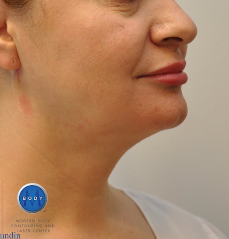 J-Plasma Neck Lift Before & After Gallery - Patient 55423353 - Image 4