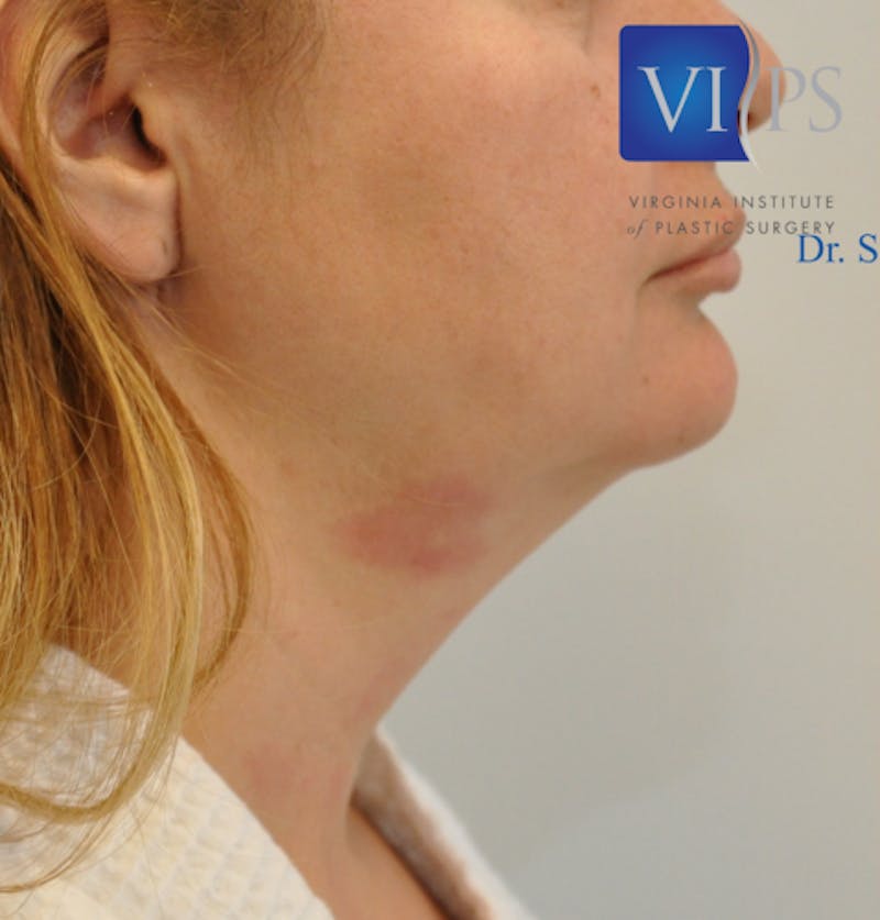 J-Plasma Neck Lift Before & After Gallery - Patient 55423353 - Image 5