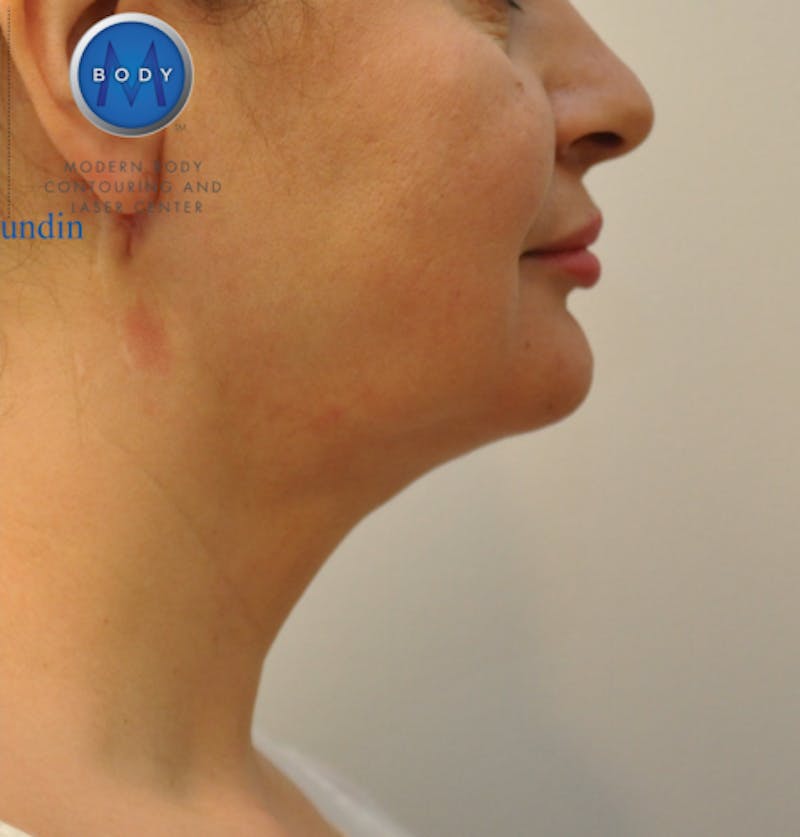 J-Plasma Neck Lift Before & After Gallery - Patient 55423353 - Image 6