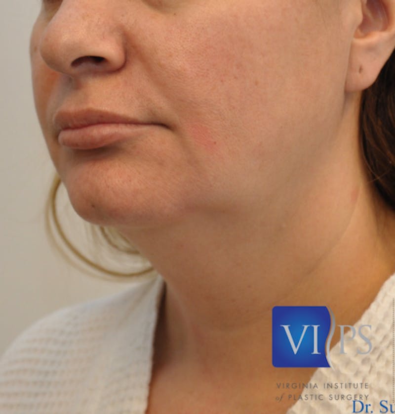 J-Plasma Neck Lift Before & After Gallery - Patient 55423353 - Image 7
