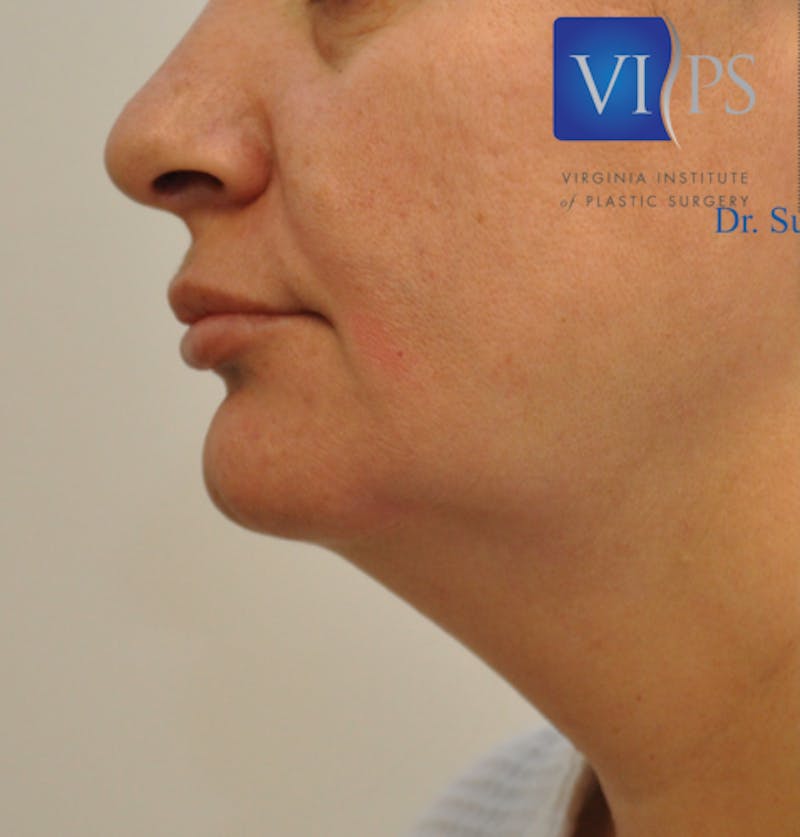 J-Plasma Neck Lift Before & After Gallery - Patient 55423353 - Image 9
