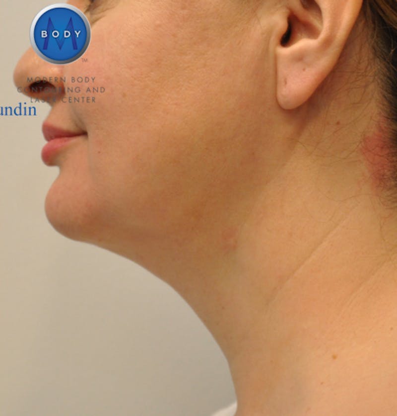 J-Plasma Neck Lift Before & After Gallery - Patient 55423353 - Image 10