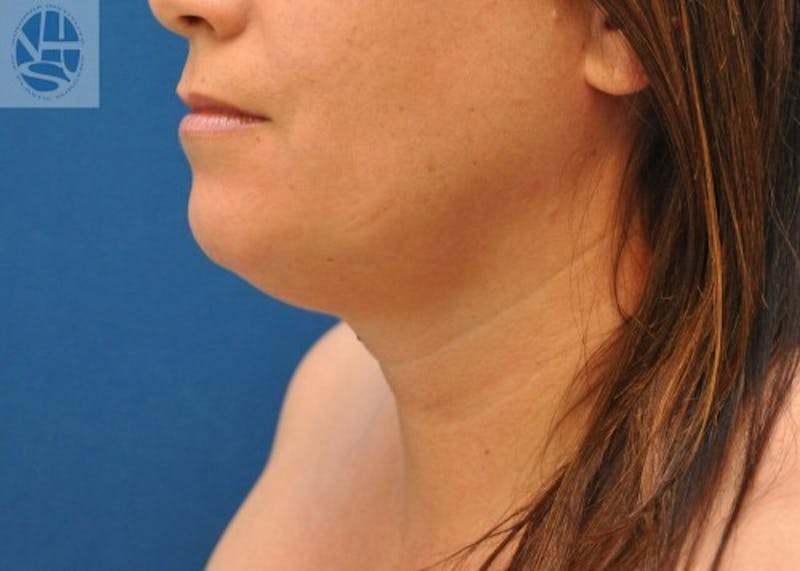 Neck Liposuction Gallery - Patient 55423385 - Image 3
