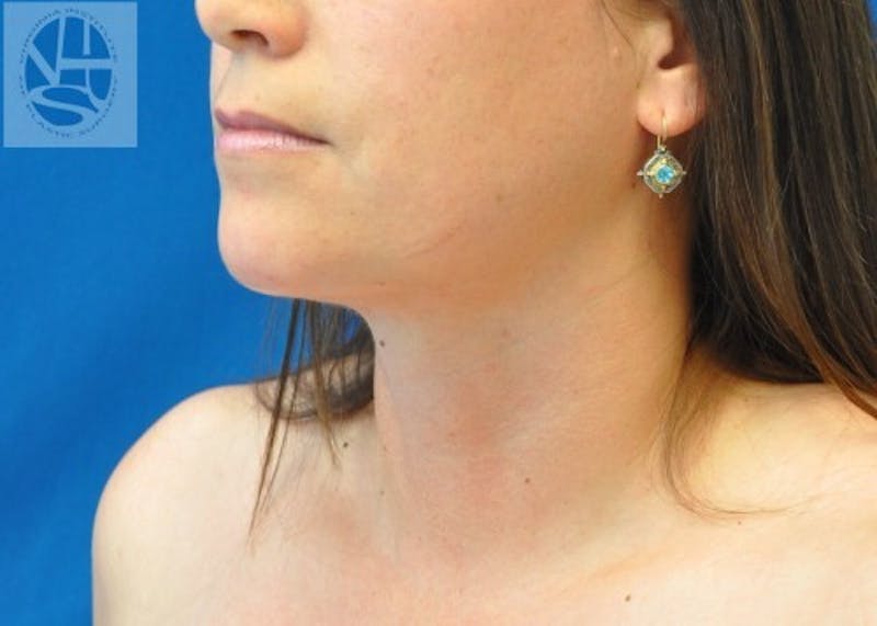 Neck Liposuction Gallery - Patient 55423385 - Image 4