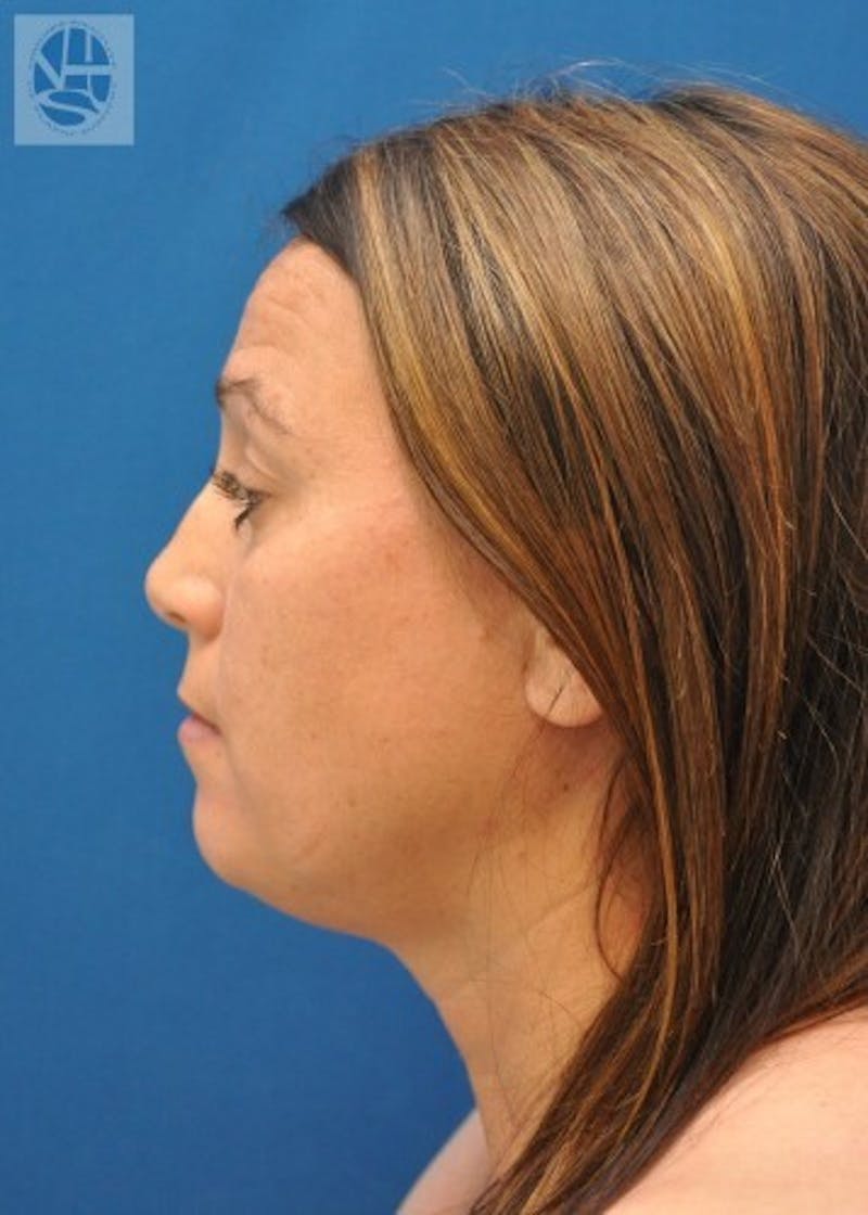 Neck Liposuction Before & After Gallery - Patient 55423385 - Image 5
