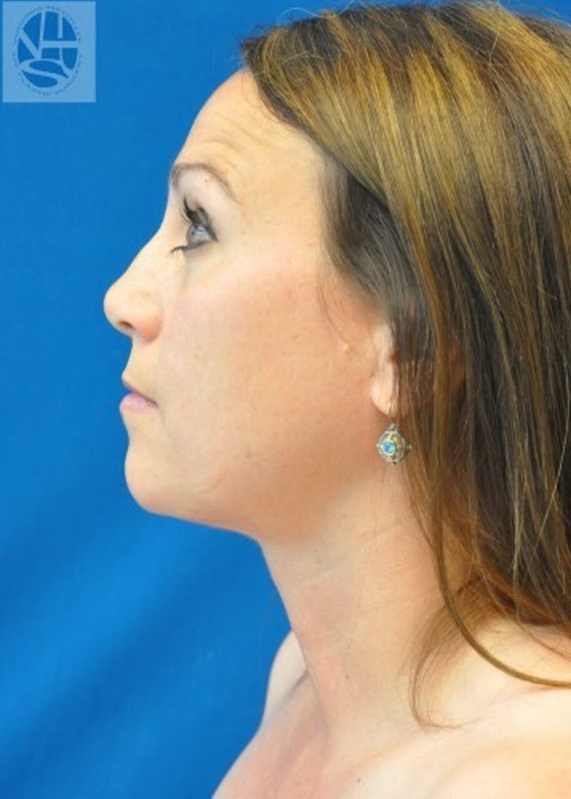 Neck Liposuction Before & After Gallery - Patient 55423385 - Image 6
