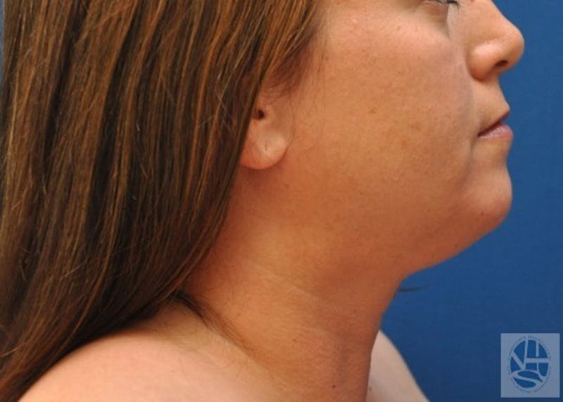 Neck Liposuction Before & After Gallery - Patient 55423385 - Image 7
