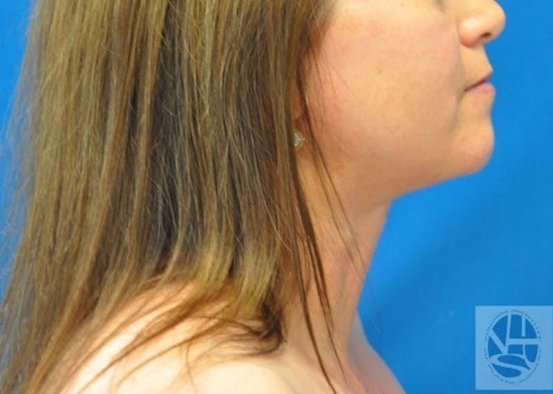 Neck Liposuction Before & After Gallery - Patient 55423385 - Image 8