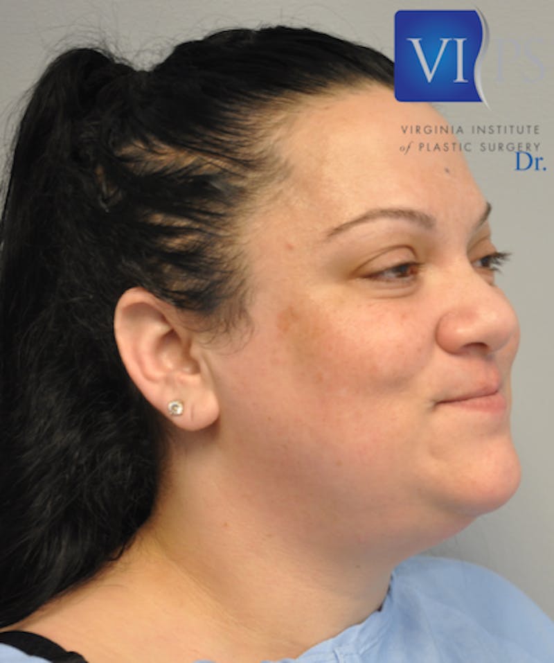 Neck Liposuction Before & After Gallery - Patient 55423386 - Image 3