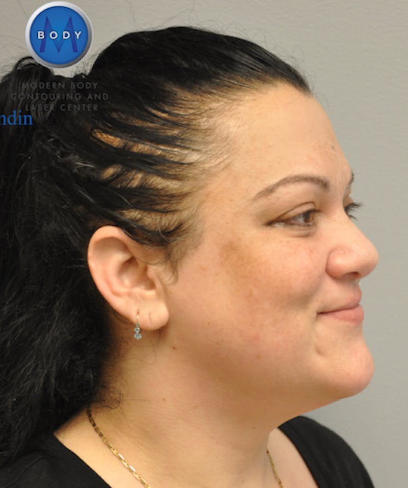Neck Liposuction Before & After Gallery - Patient 55423386 - Image 4