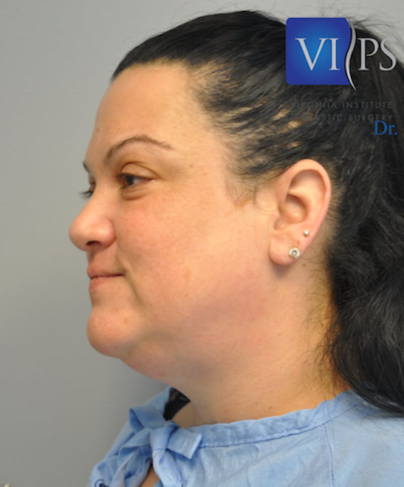 Neck Liposuction Before & After Gallery - Patient 55423386 - Image 7