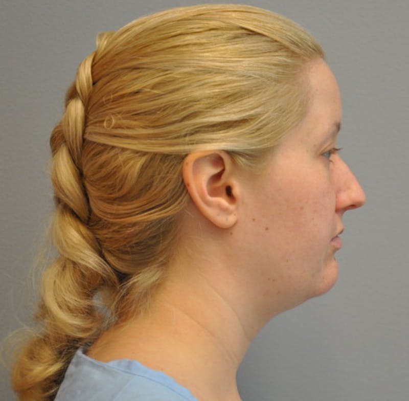 Neck Liposuction Before & After Gallery - Patient 55423387 - Image 5