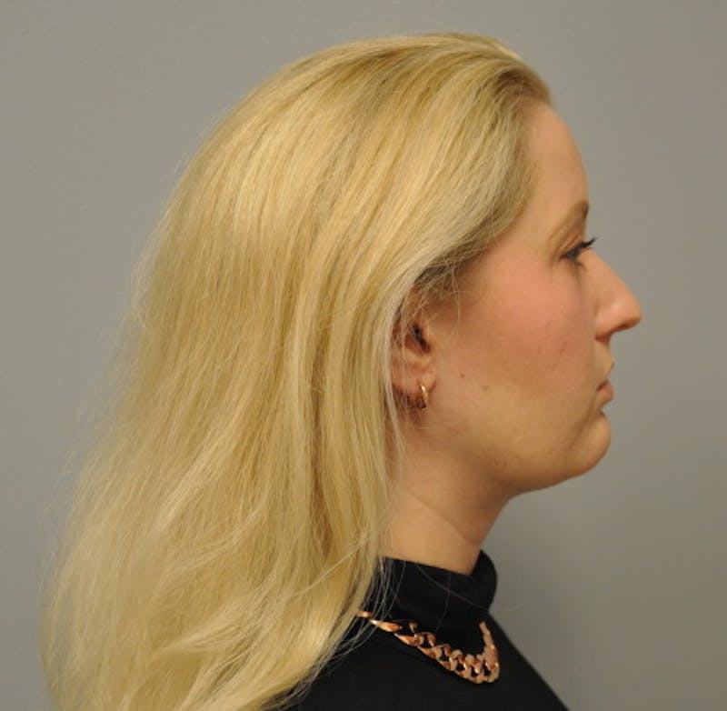 Neck Liposuction Before & After Gallery - Patient 55423387 - Image 6