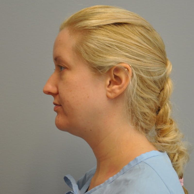 Neck Liposuction Before & After Gallery - Patient 55423387 - Image 9