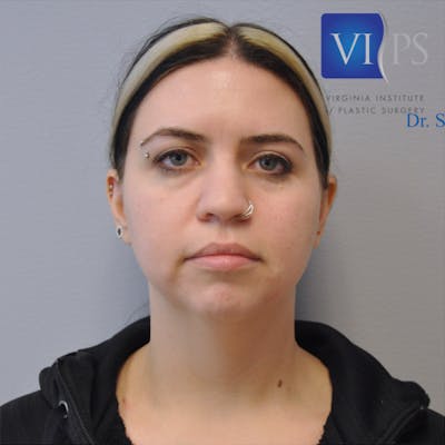 Neck Liposuction Before & After Gallery - Patient 55423388 - Image 1