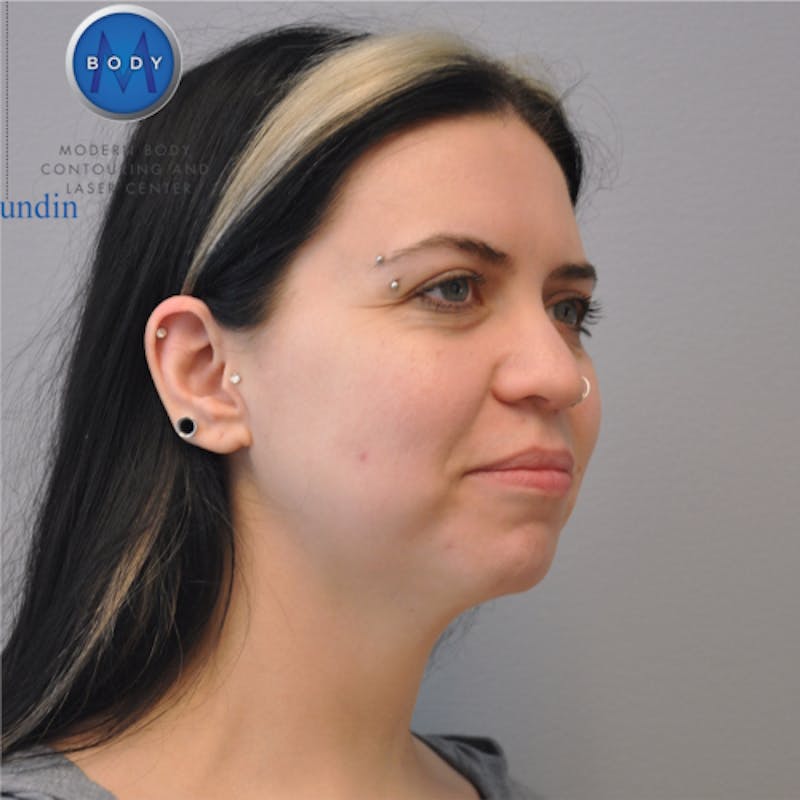 Neck Liposuction Before & After Gallery - Patient 55423388 - Image 4