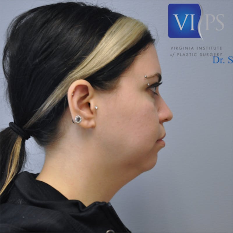 Neck Liposuction Before & After Gallery - Patient 55423388 - Image 5