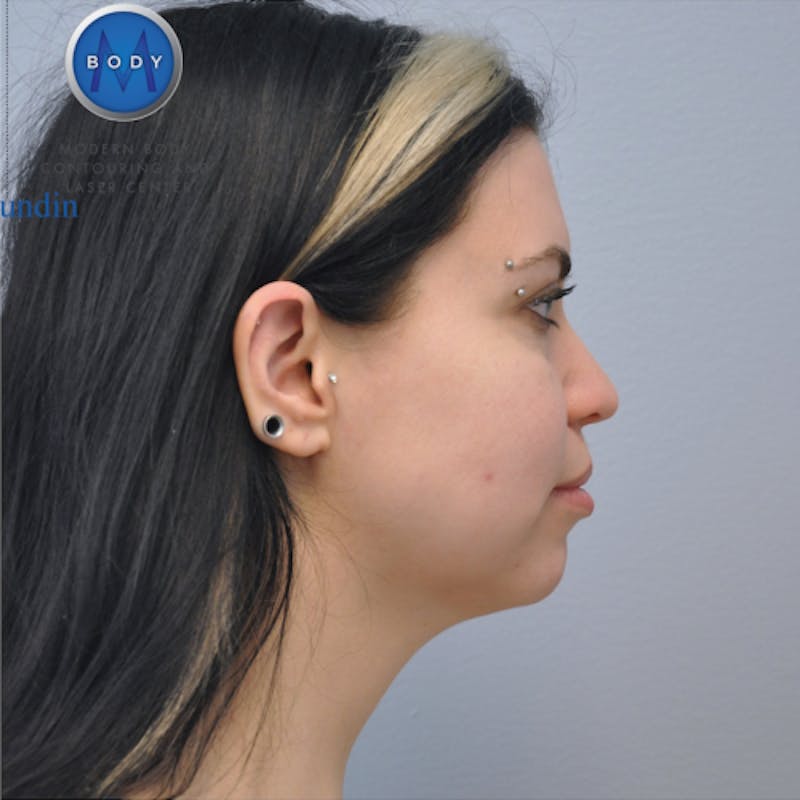 Neck Liposuction Before & After Gallery - Patient 55423388 - Image 6