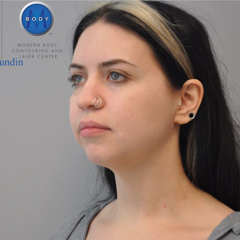 Neck Liposuction Before & After Gallery - Patient 55423388 - Image 8