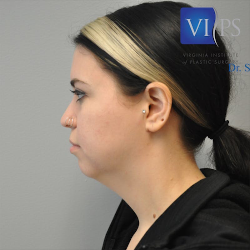 Neck Liposuction Before & After Gallery - Patient 55423388 - Image 9