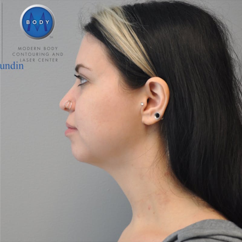 Neck Liposuction Before & After Gallery - Patient 55423388 - Image 10