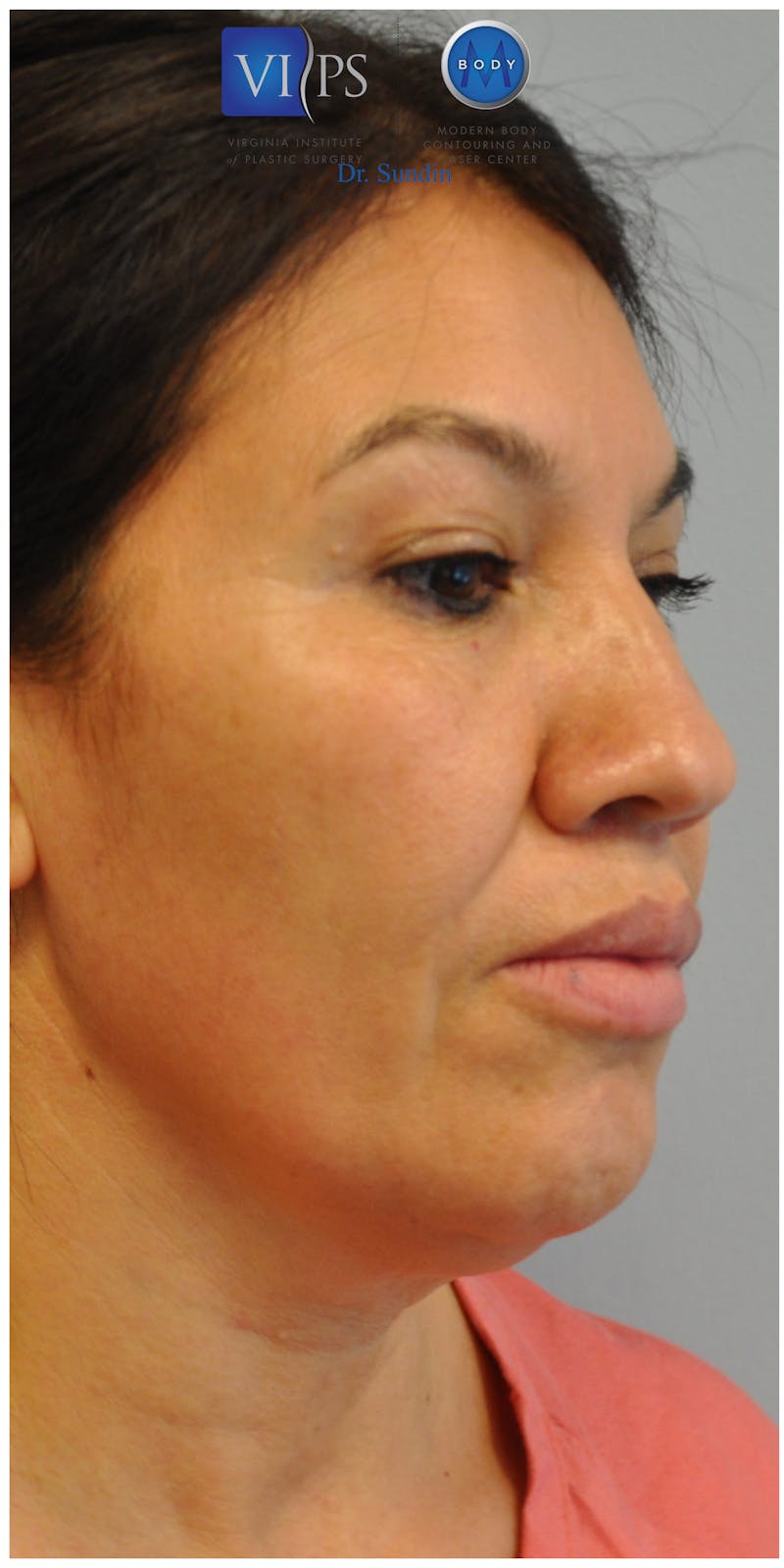 Facelift Before & After Gallery - Patient 110235562 - Image 1
