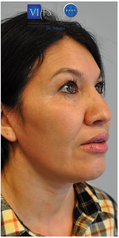 Neck Lift Before & After Gallery - Patient 110235566 - Image 2