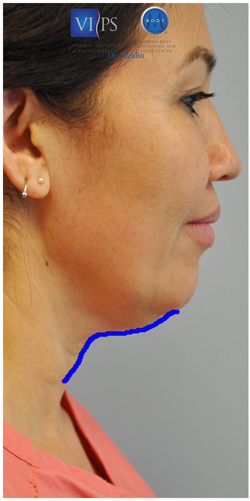 Neck Lift Before & After Gallery - Patient 110235566 - Image 3