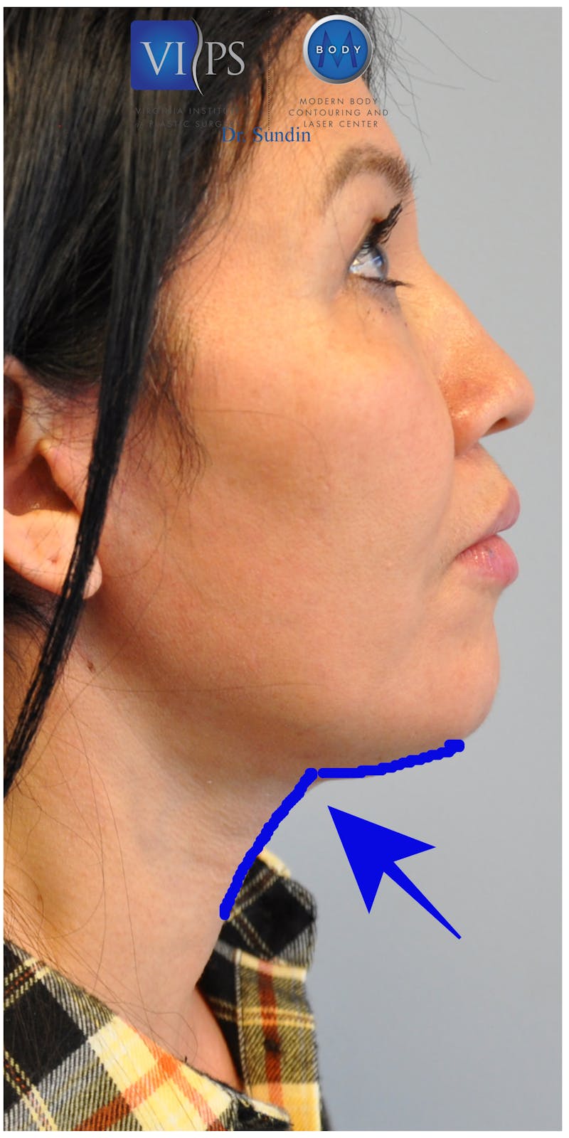 Neck Lift Before & After Gallery - Patient 110235566 - Image 4
