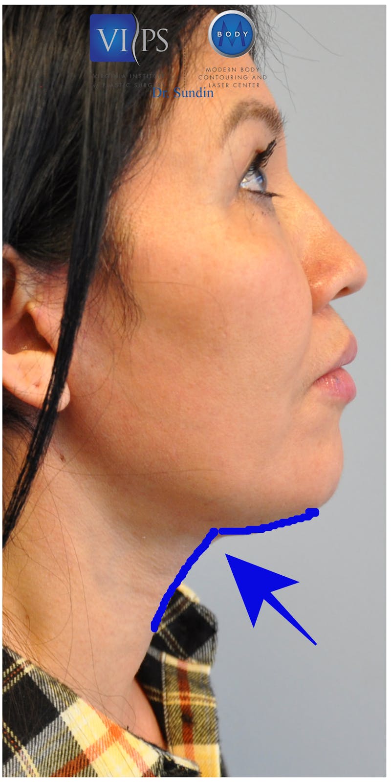 Facelift Before & After Gallery - Patient 110235562 - Image 4