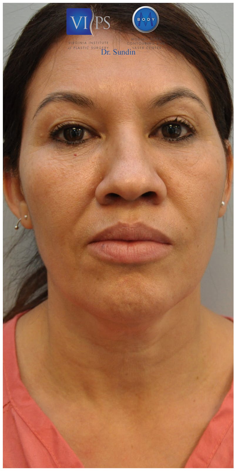 Neck Lift Before & After Gallery - Patient 110235566 - Image 5