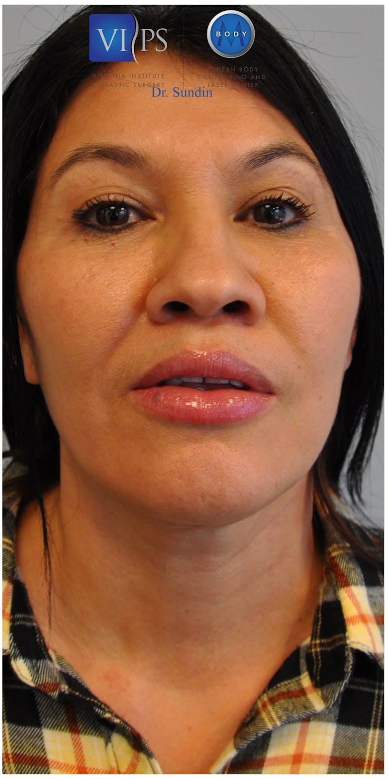 Neck Lift Before & After Gallery - Patient 110235566 - Image 6